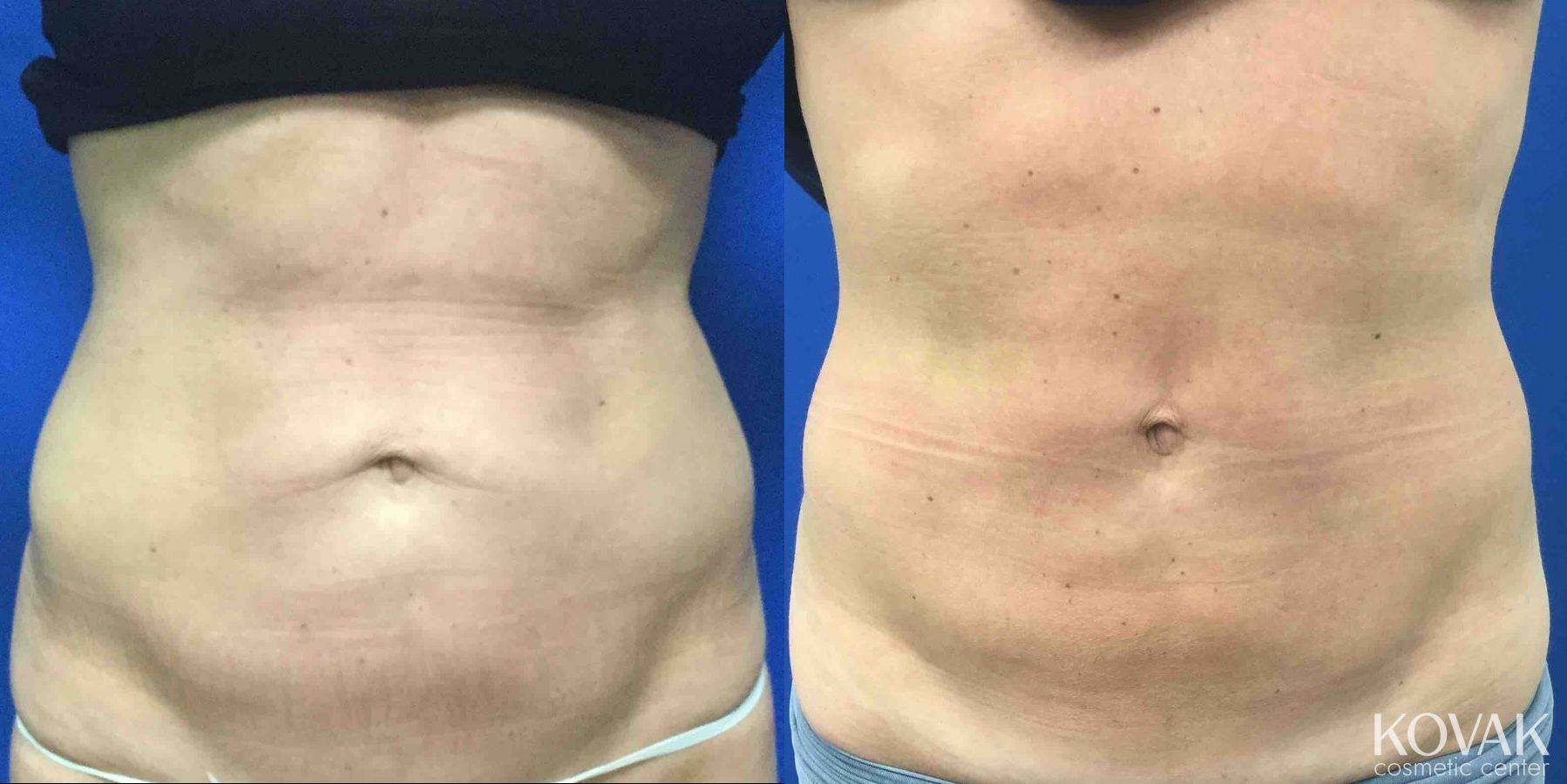 Before and after EMSCULPTĀ® case 36684