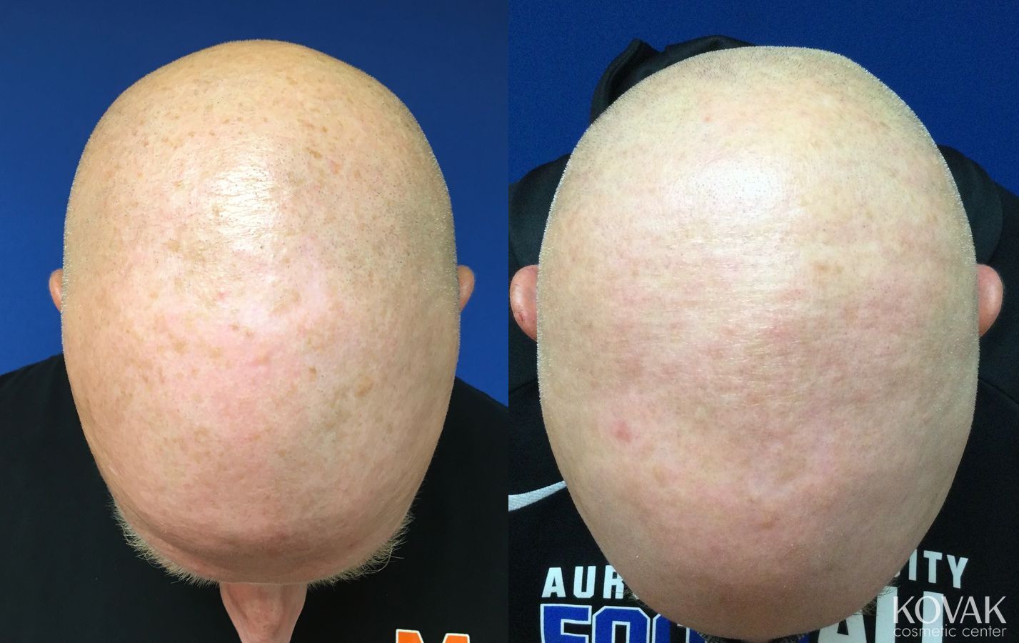 Before and after Tyte and Bryte Photorejuvenation case 36708
