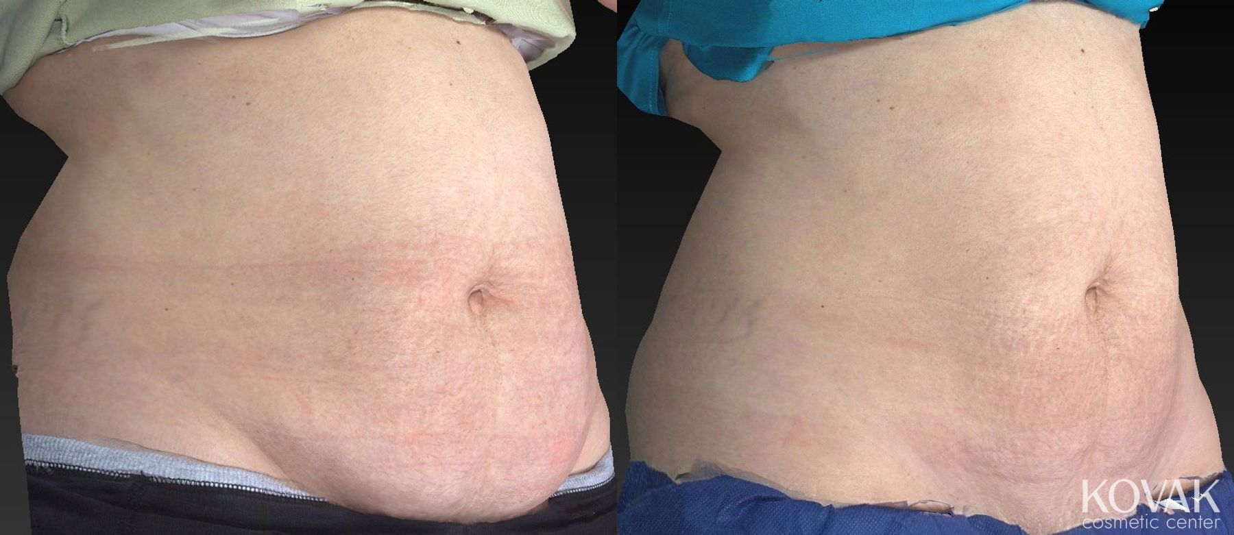 Before and after CoolSculpting® case 36459 - Angle 2