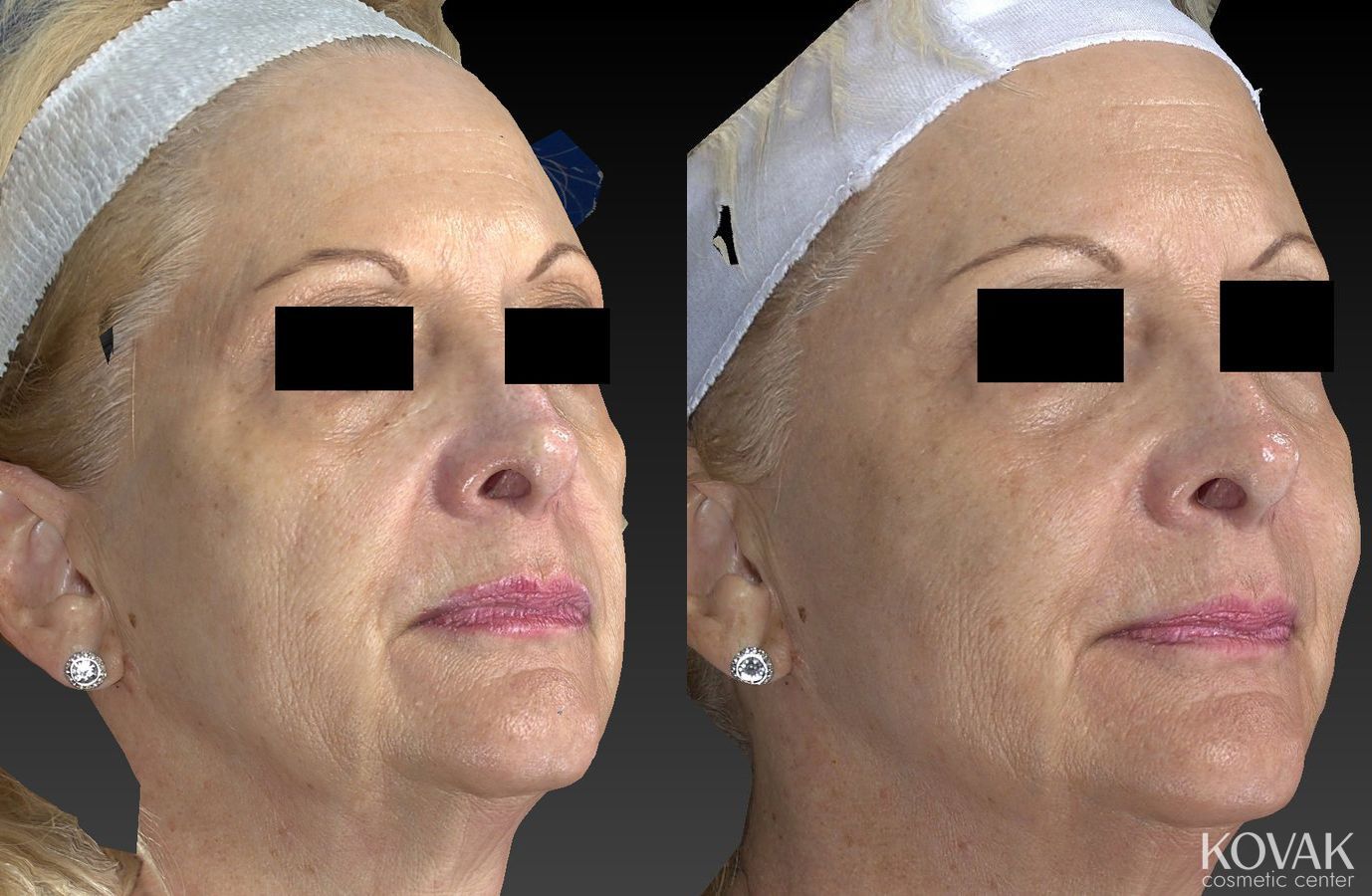 Before and after Sculptra® case 36618 - Angle 5