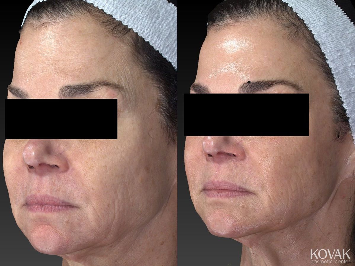 Before and after Halo™ case 36585 - Angle 3