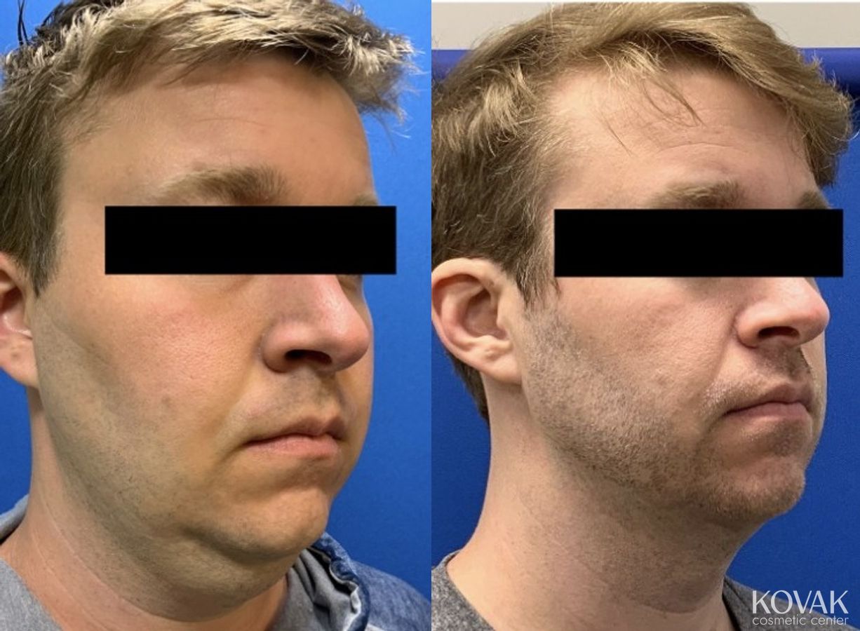 Before and after VLR - Vaser Laser - Jawline Sculpting case 36766 - Angle 5