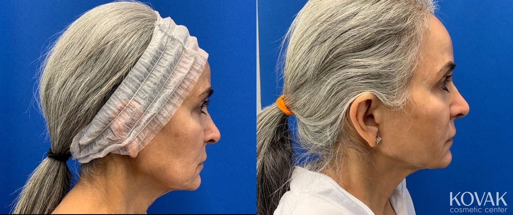 Before and after VLR - Vaser Laser - Jawline Sculpting case 36759
