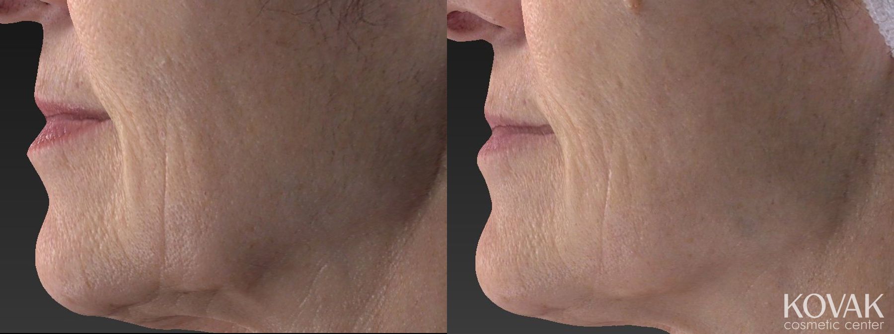 Before and after Restylane® Silk case 36462 - Angle 3