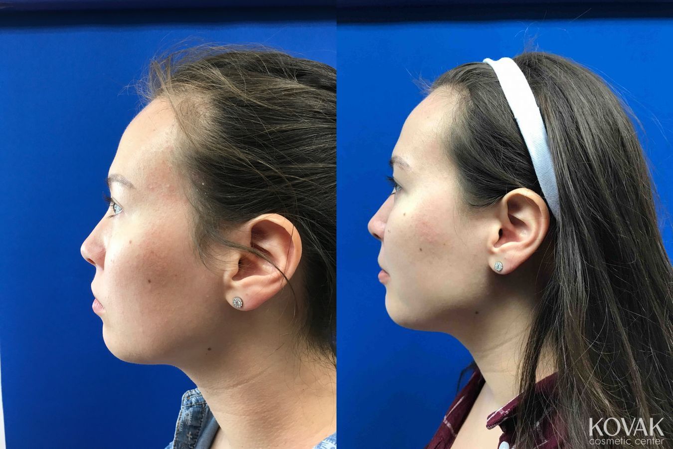 Before and after Restylane® Lyft case 36625