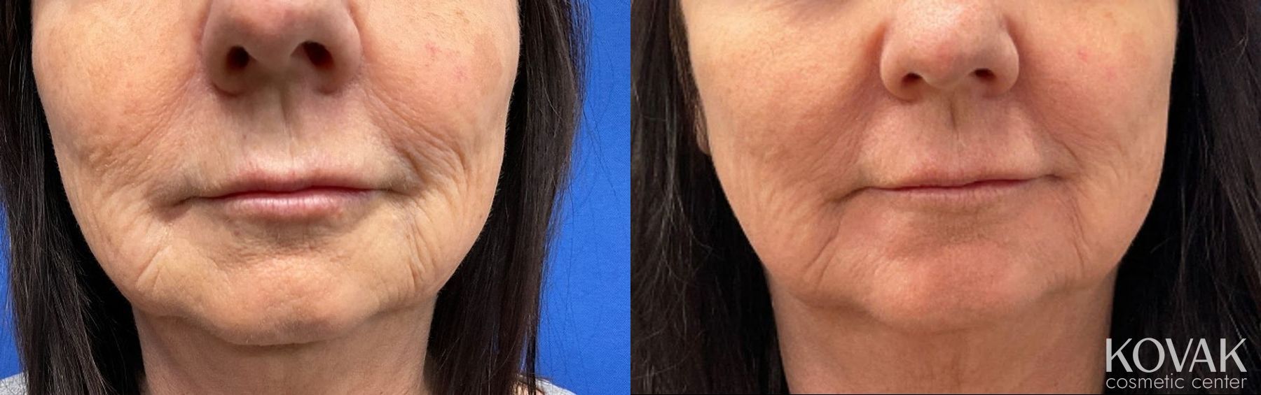 Before and after Facelift & Neck Lift case 36762