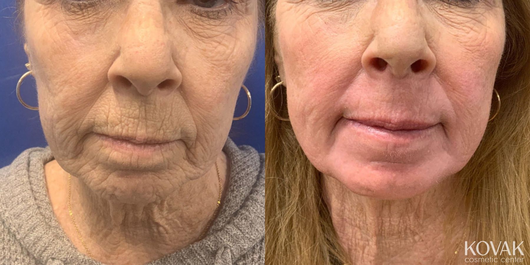 Before and after Laser Skin Resurfacing - Face case 36767