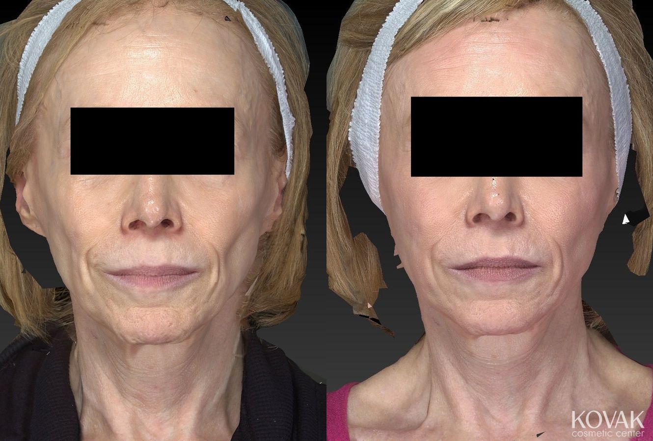 Before and after Sculptra® case 36464