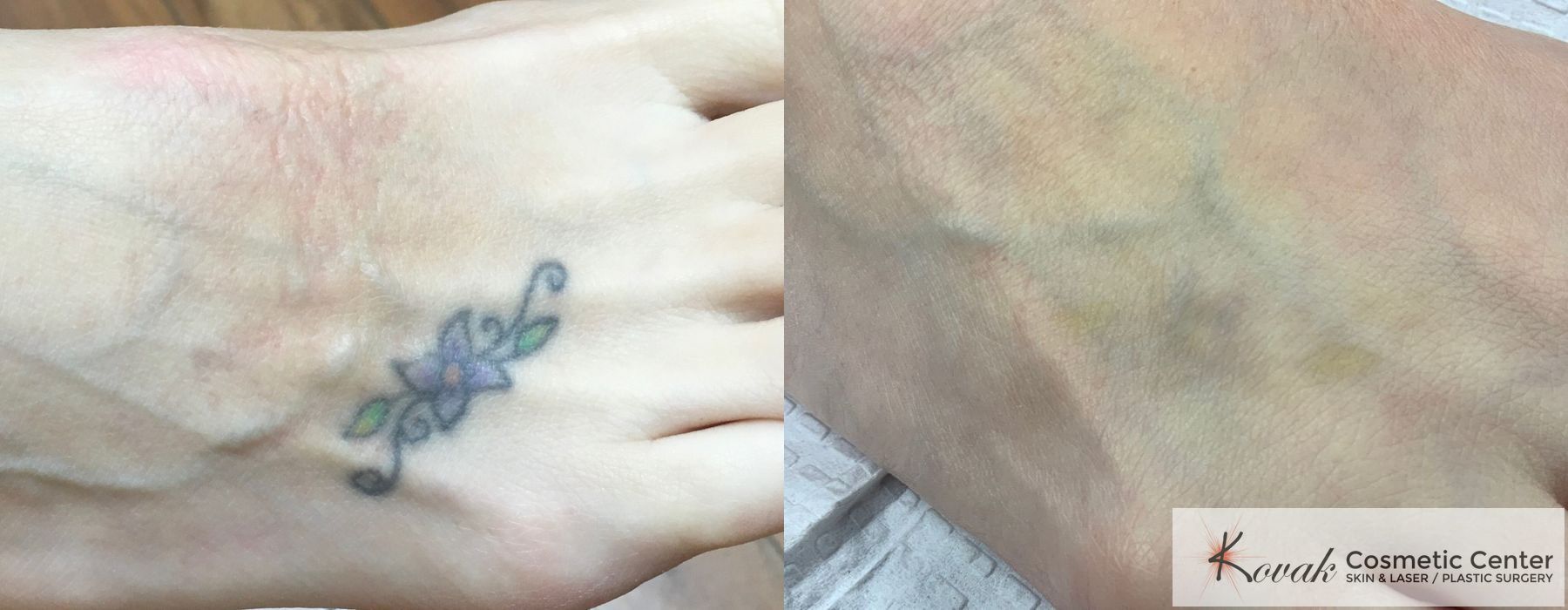 Tattoo Removal - Case 1700