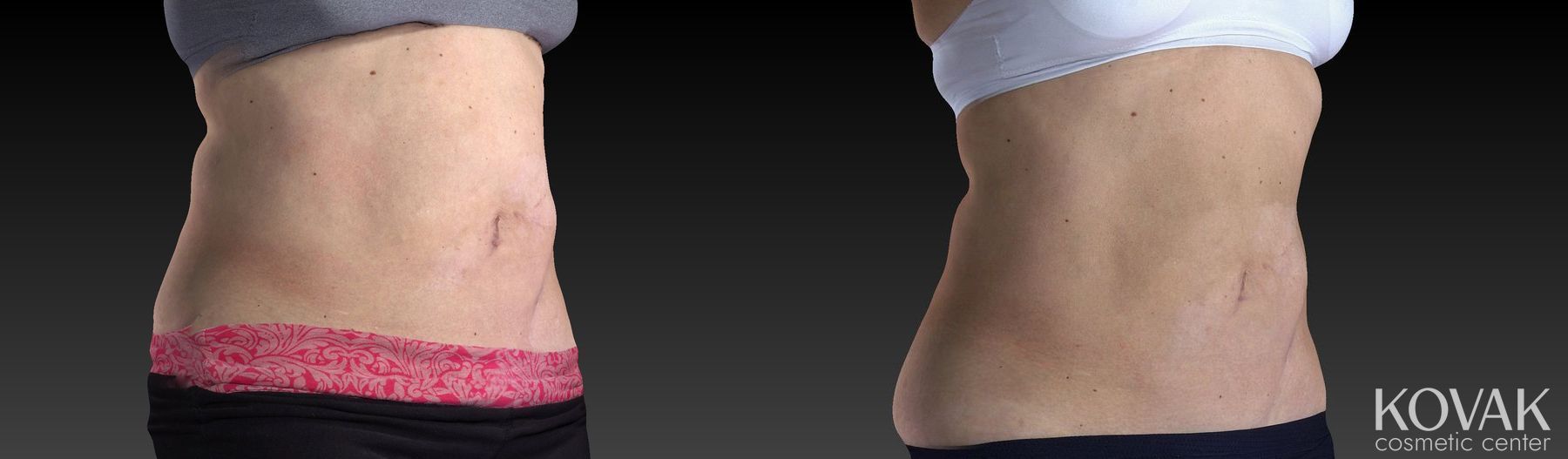 Before and after CoolSculpting® case 36542 - Angle 2