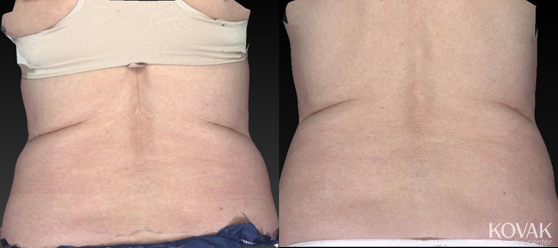 Before and after CoolSculpting® case 36484 - Angle 5