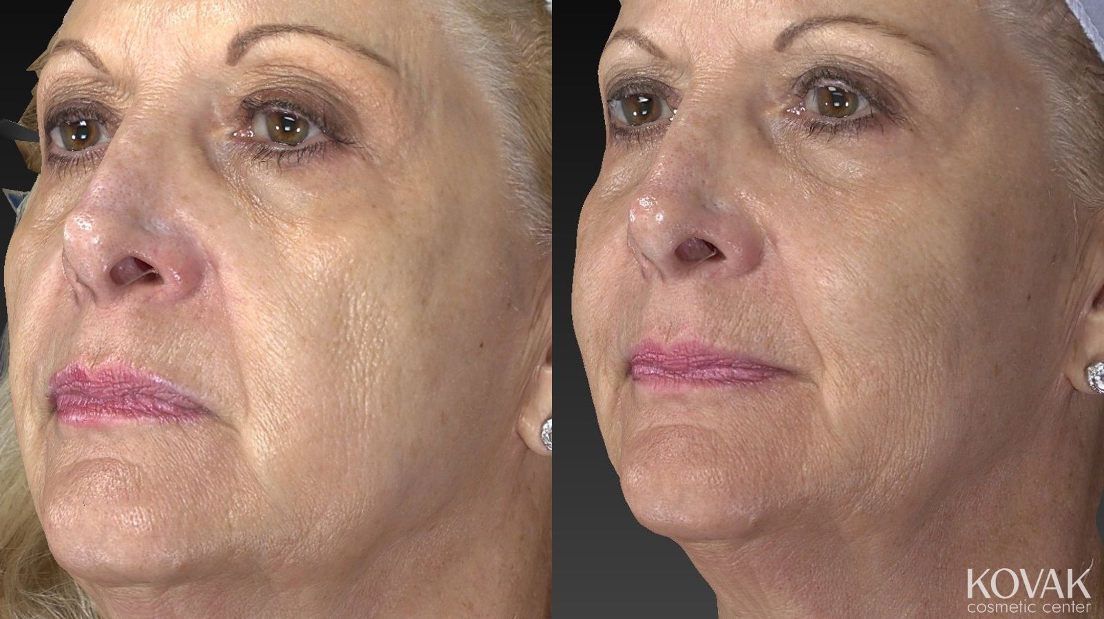 Before and after Injectables - Face case 36537 - Angle 2