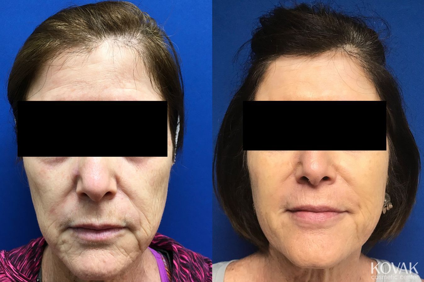 Before and after Facial Volume case 36453
