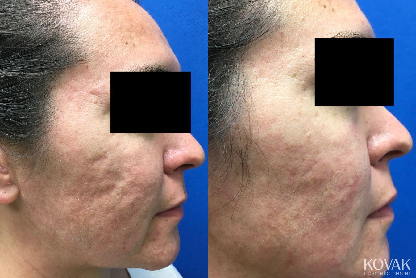 Before and after Acne Scars case 36697