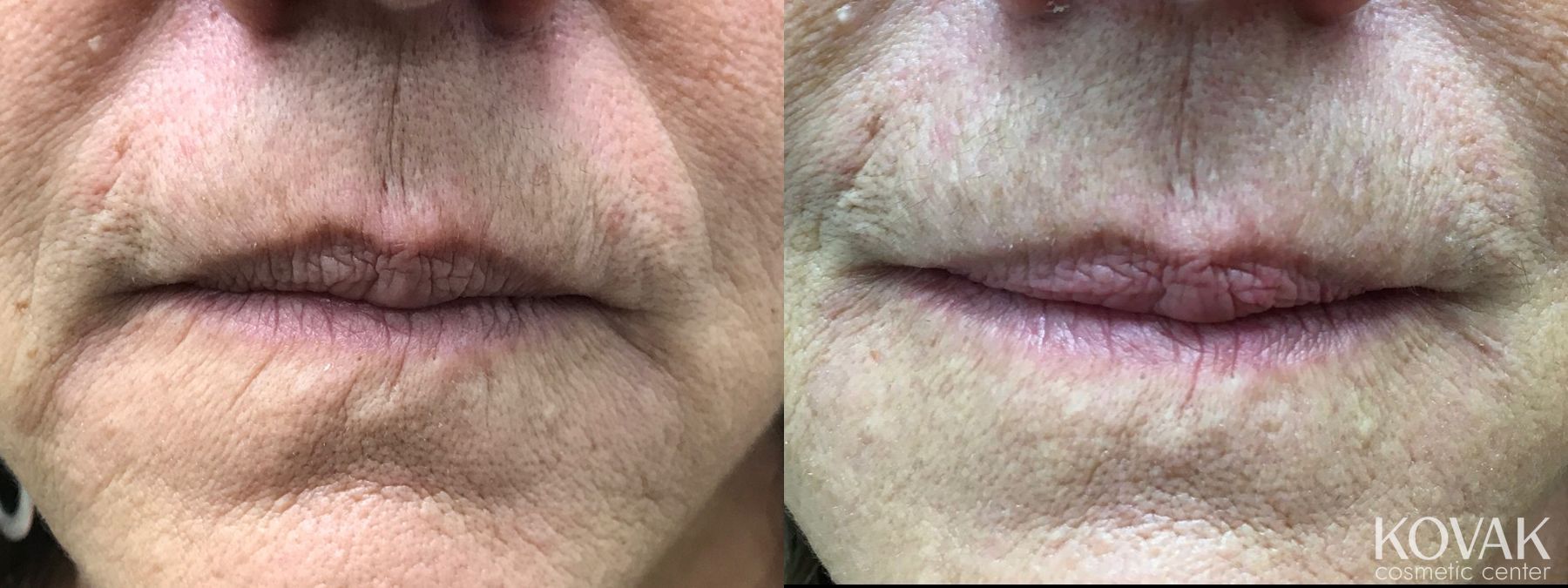 Before and after Lips - Fine Lines case 36571