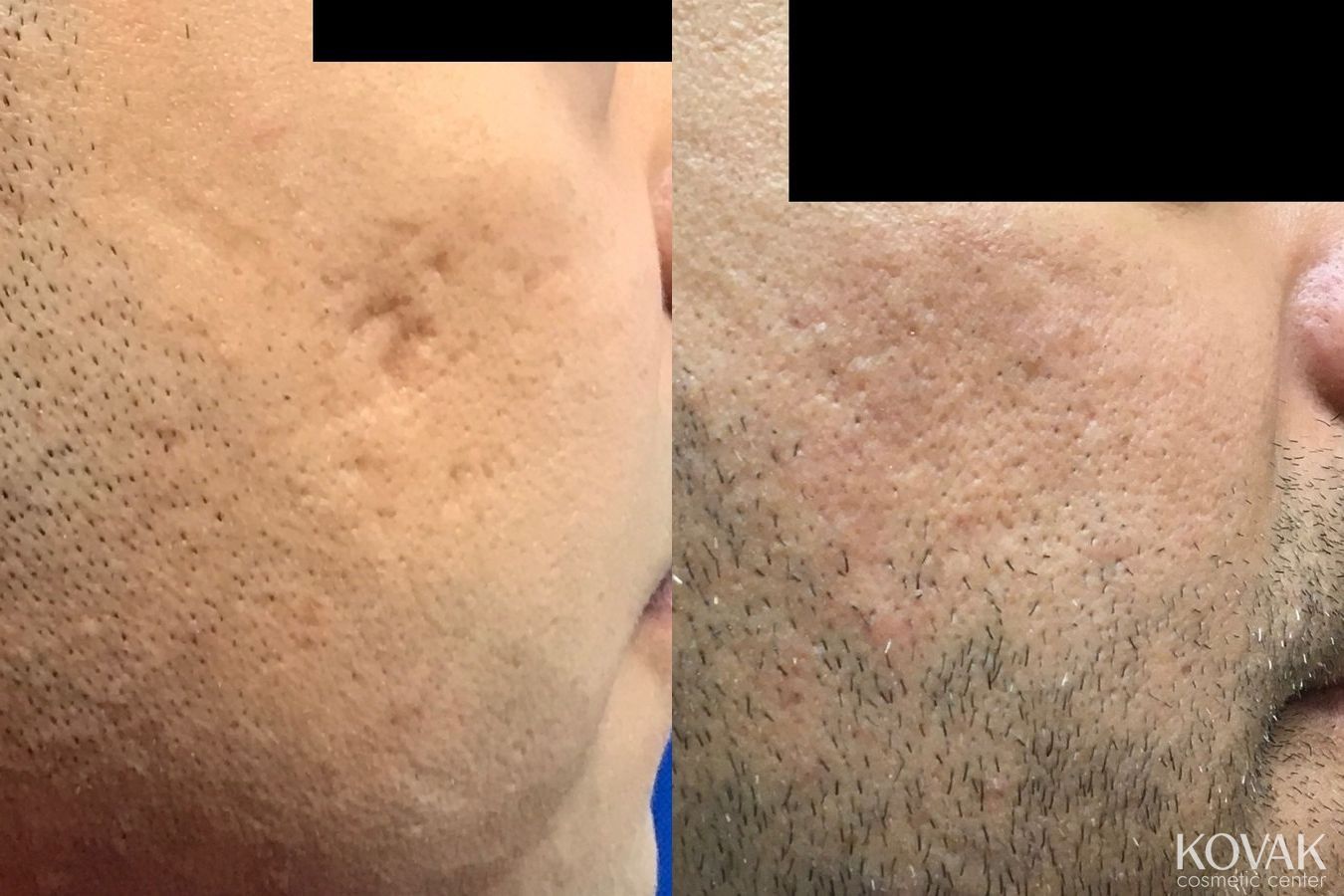 Before and after Acne Scars case 36642 - Angle 2