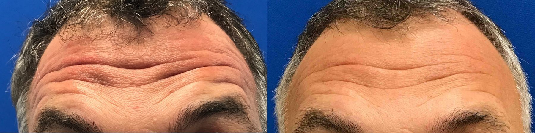 Before and after Forehead Lines case 36539