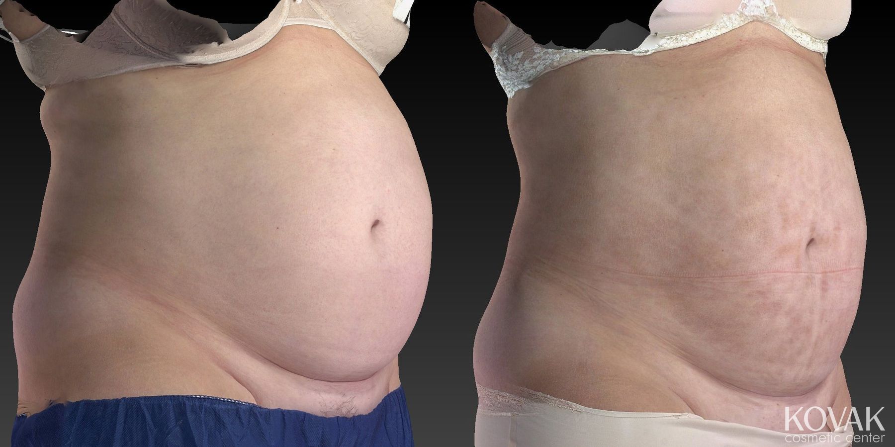 Before and after CoolSculpting® case 36481 - Angle 4