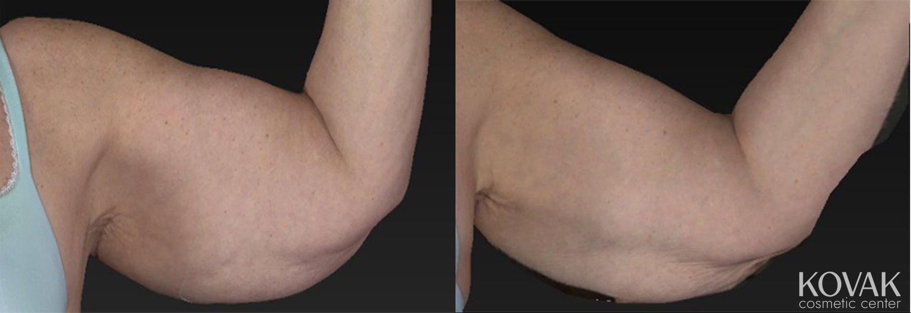 Before and after CoolSculpting® case 36469 - Angle 2