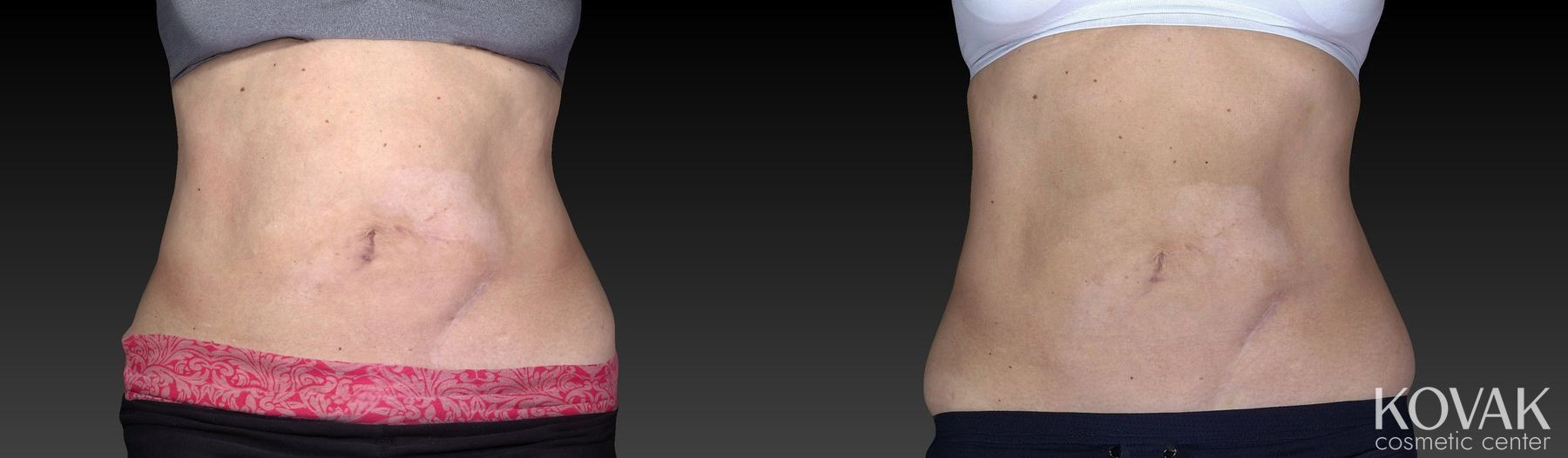 Before and after CoolSculpting® case 36542