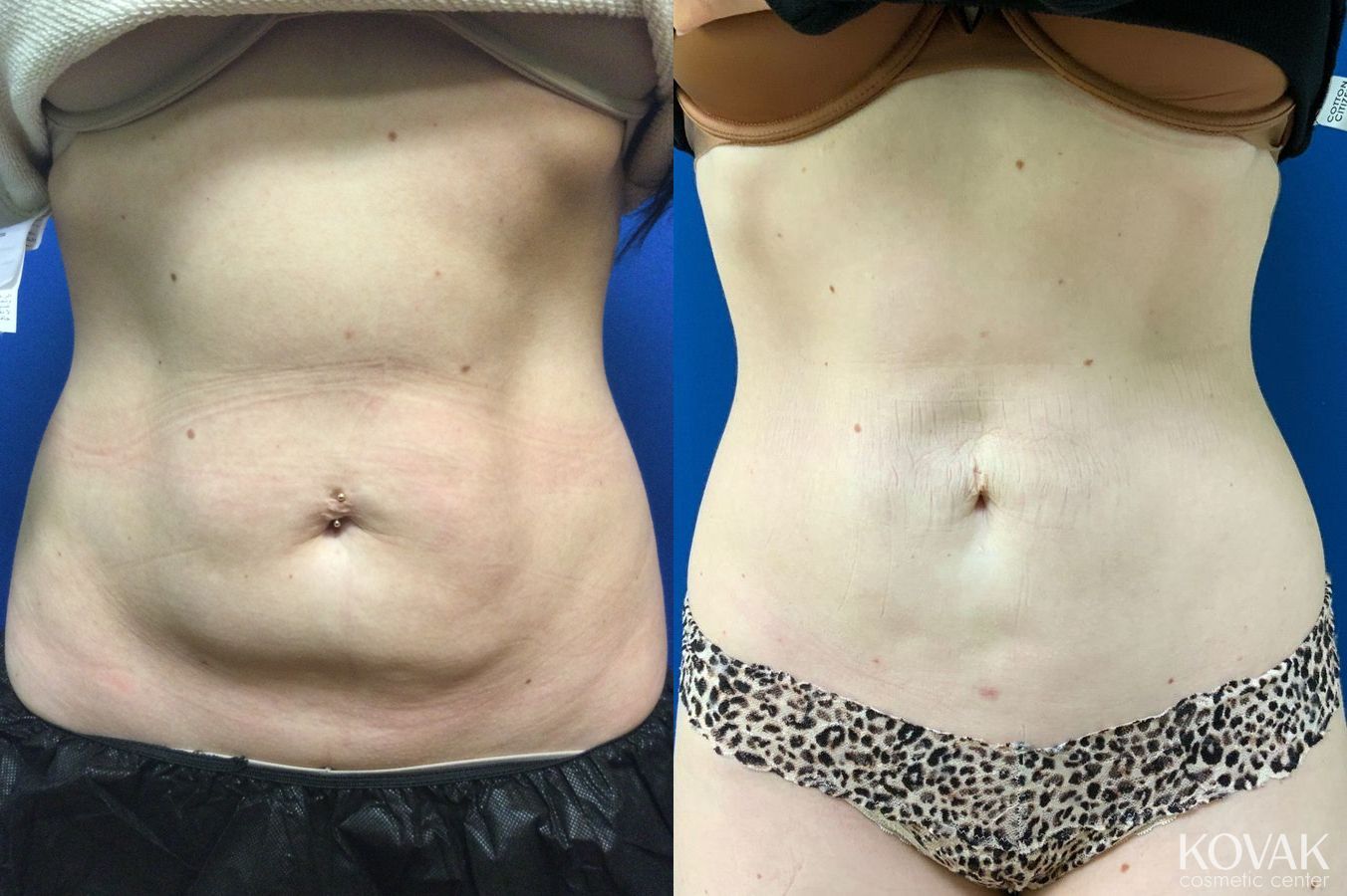 Before and after Emsculpt Neo case 36700