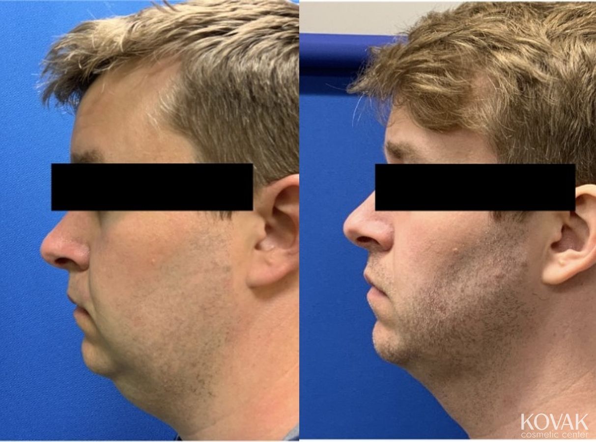 Before and after VLR - Vaser Laser - Jawline Sculpting case 36766
