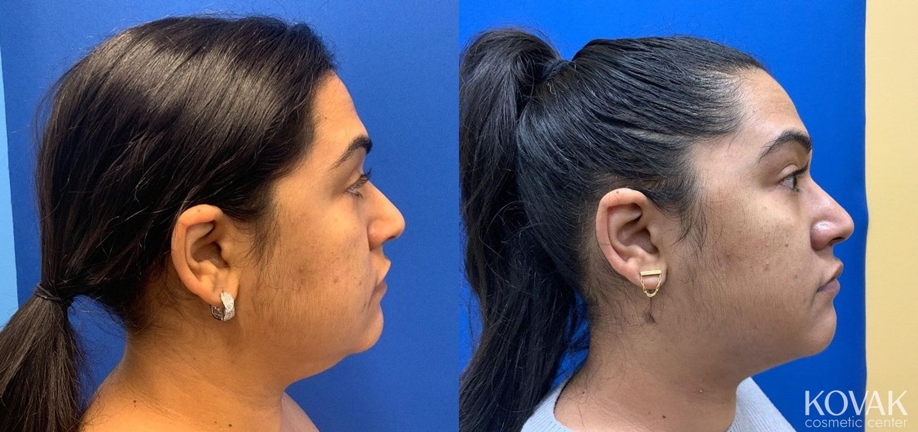 Before and after VLR - Vaser Laser - Jawline Sculpting case 36749