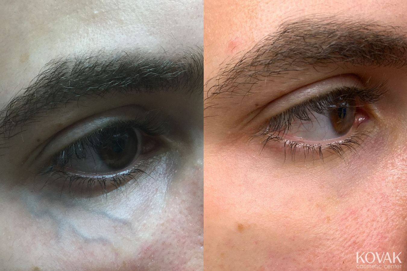 Before and after Eye Vein Treatment case 36707