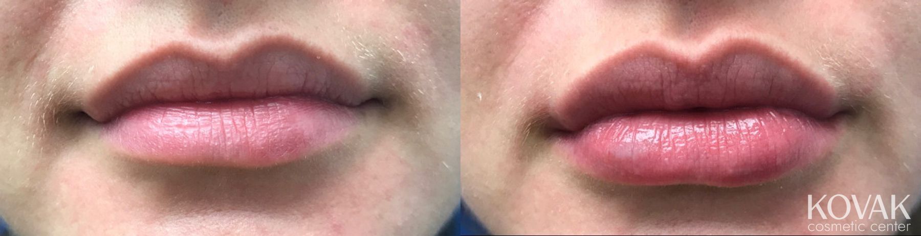 Before and after Juvéderm® XC case 36495