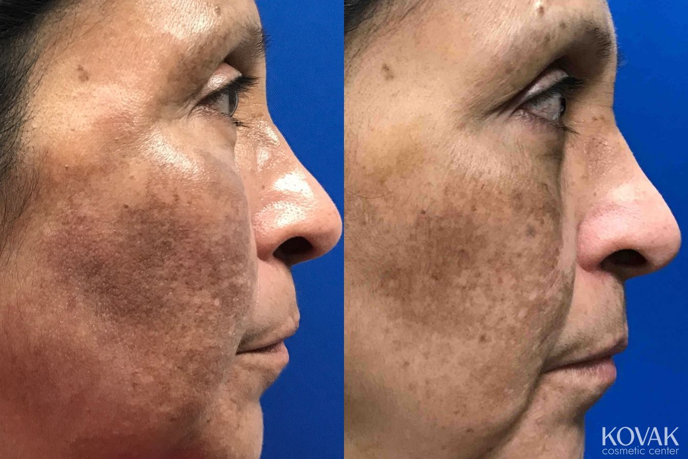 Before and after Melasma case 36615 - Angle 2
