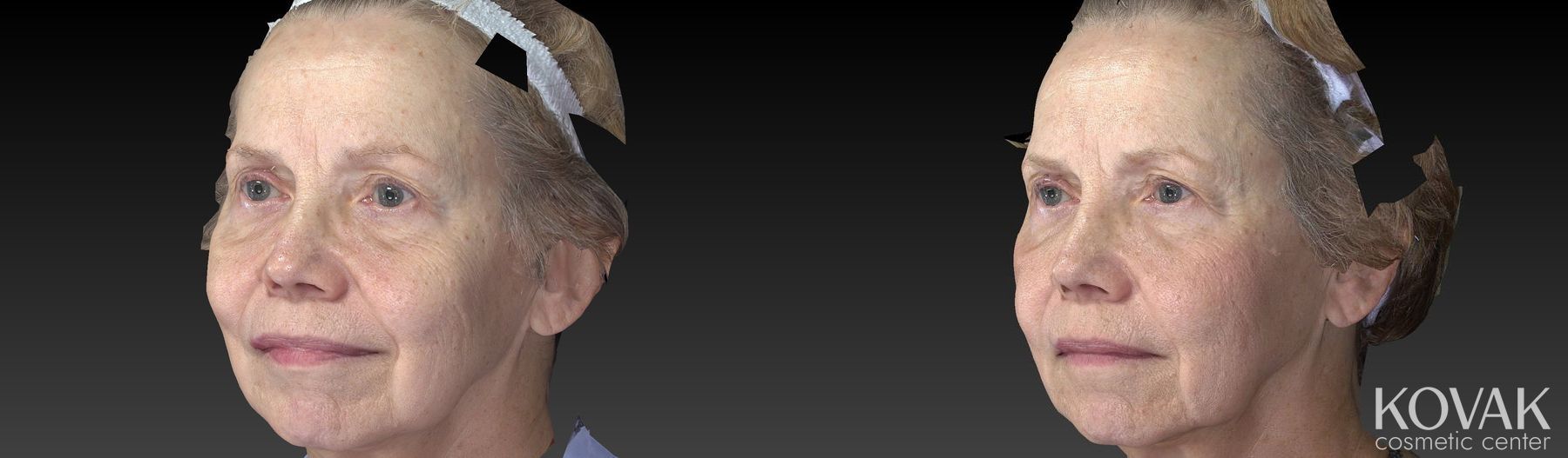 Before and after Sculptra® case 36561 - Angle 4