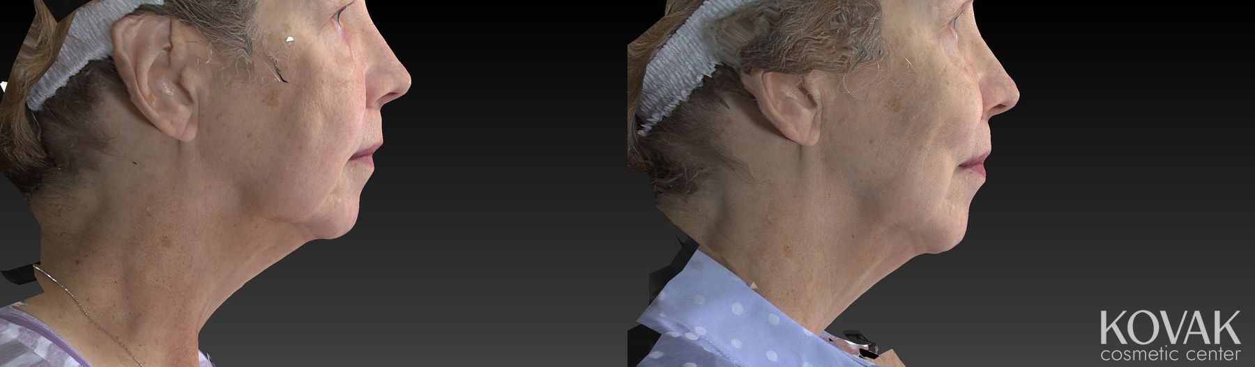 Before and after CoolSculpting® case 36456 - Angle 3