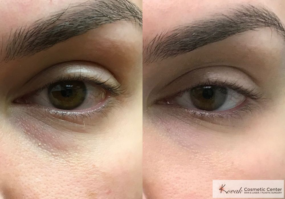 Eye Treatments - Thumbnail 2