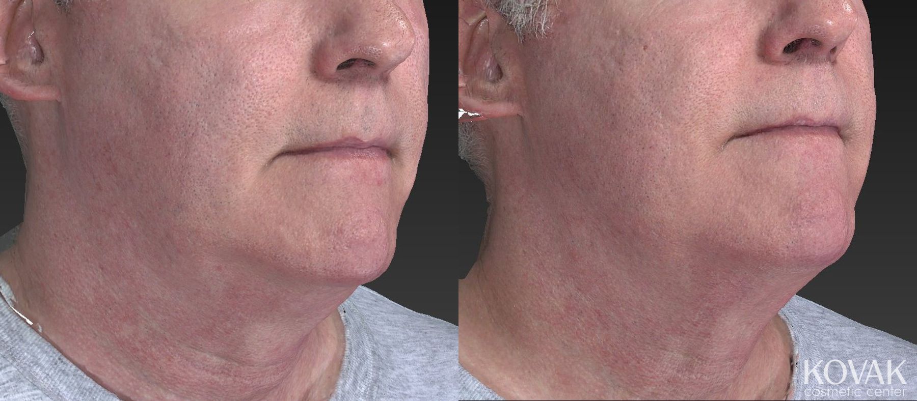 Before and after Kybella case 36640 - Angle 4