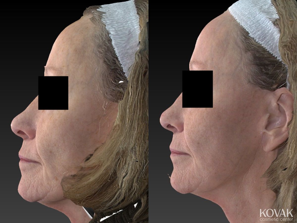 Before and after Halo™ case 36482 - Angle 5