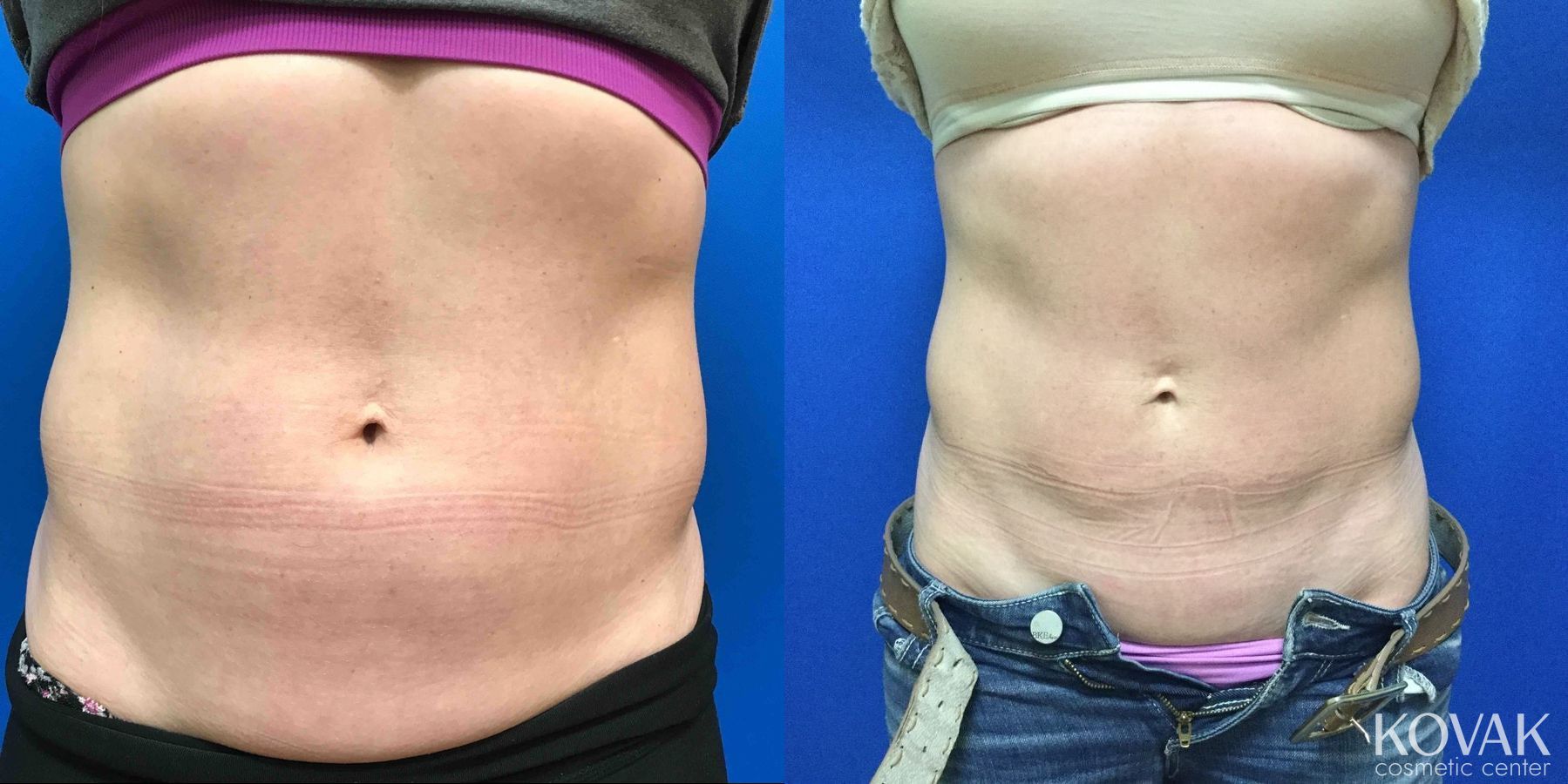 Before and after CoolSculpting® case 36461