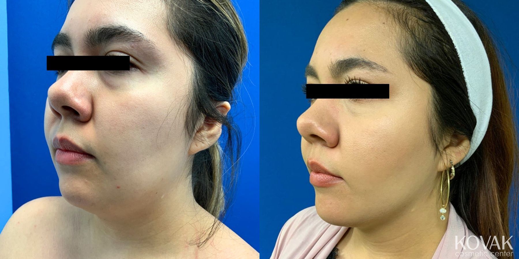 Before and after VLR - Vaser Laser - Jawline Sculpting case 36761