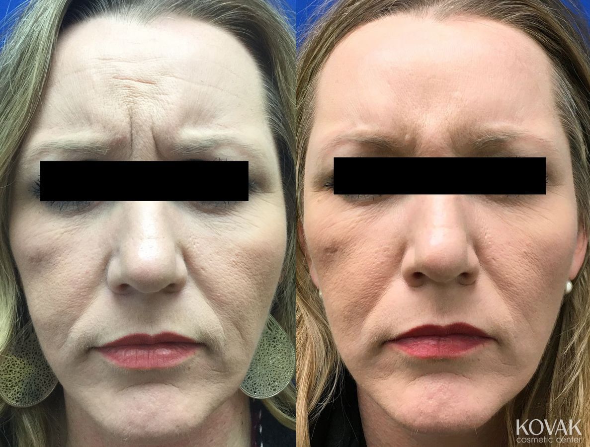 Before and after BOTOX® Cosmetic case 36678 - Angle 2