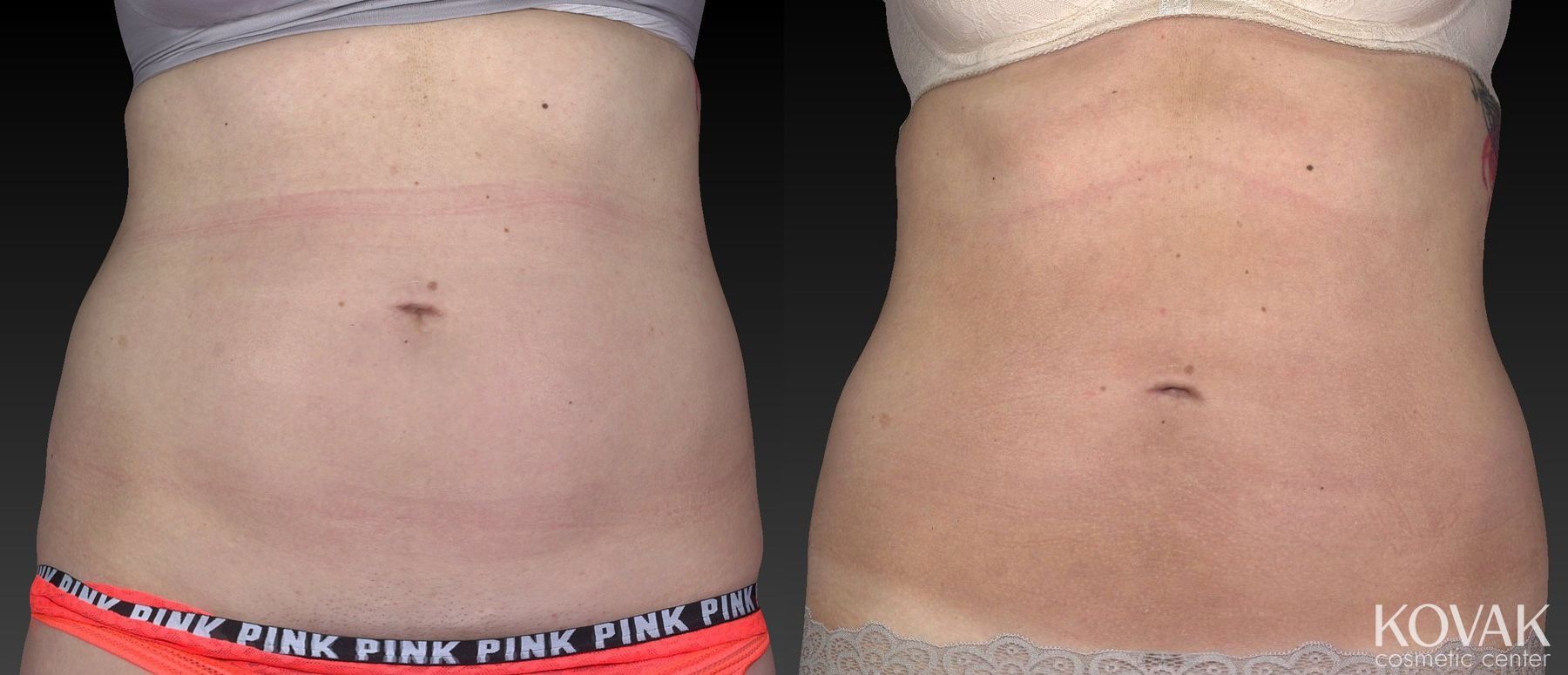 Before and after CoolSculpting® case 36619