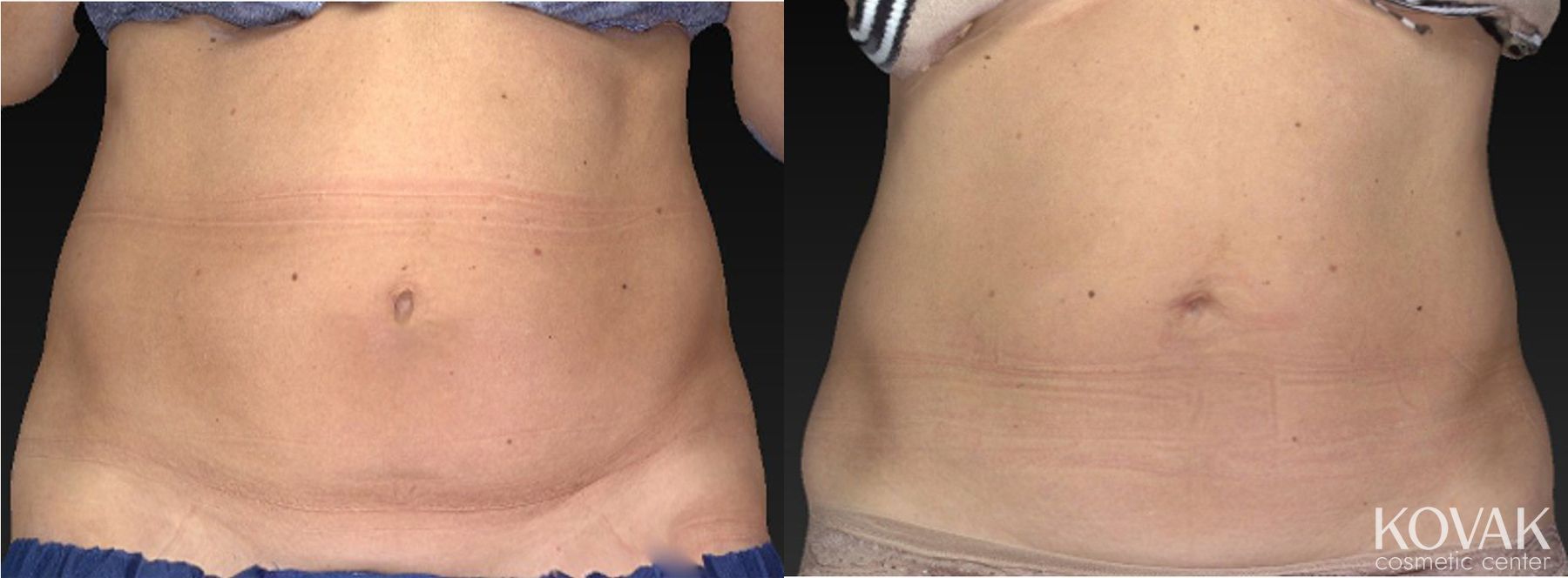 Before and after CoolSculpting® case 36486
