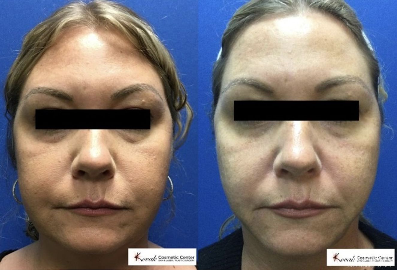 Before and after VLR - Vaser Laser - Jawline Sculpting case 36755