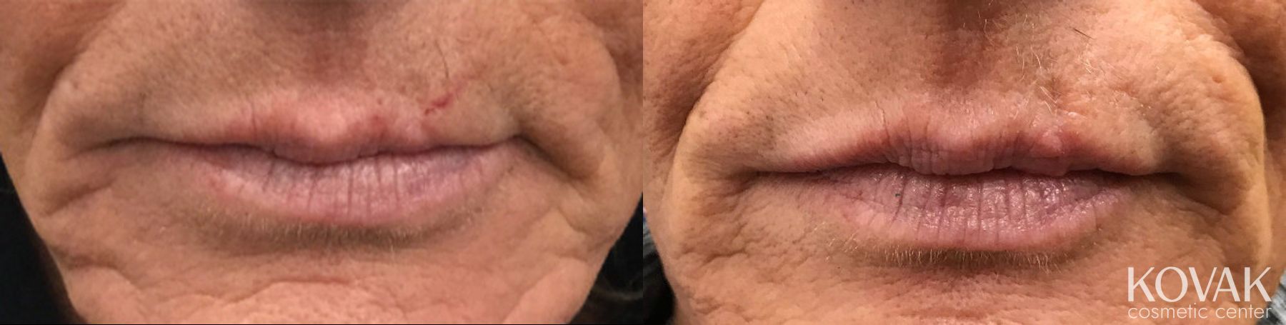 Before and after Restylane® Silk case 36488