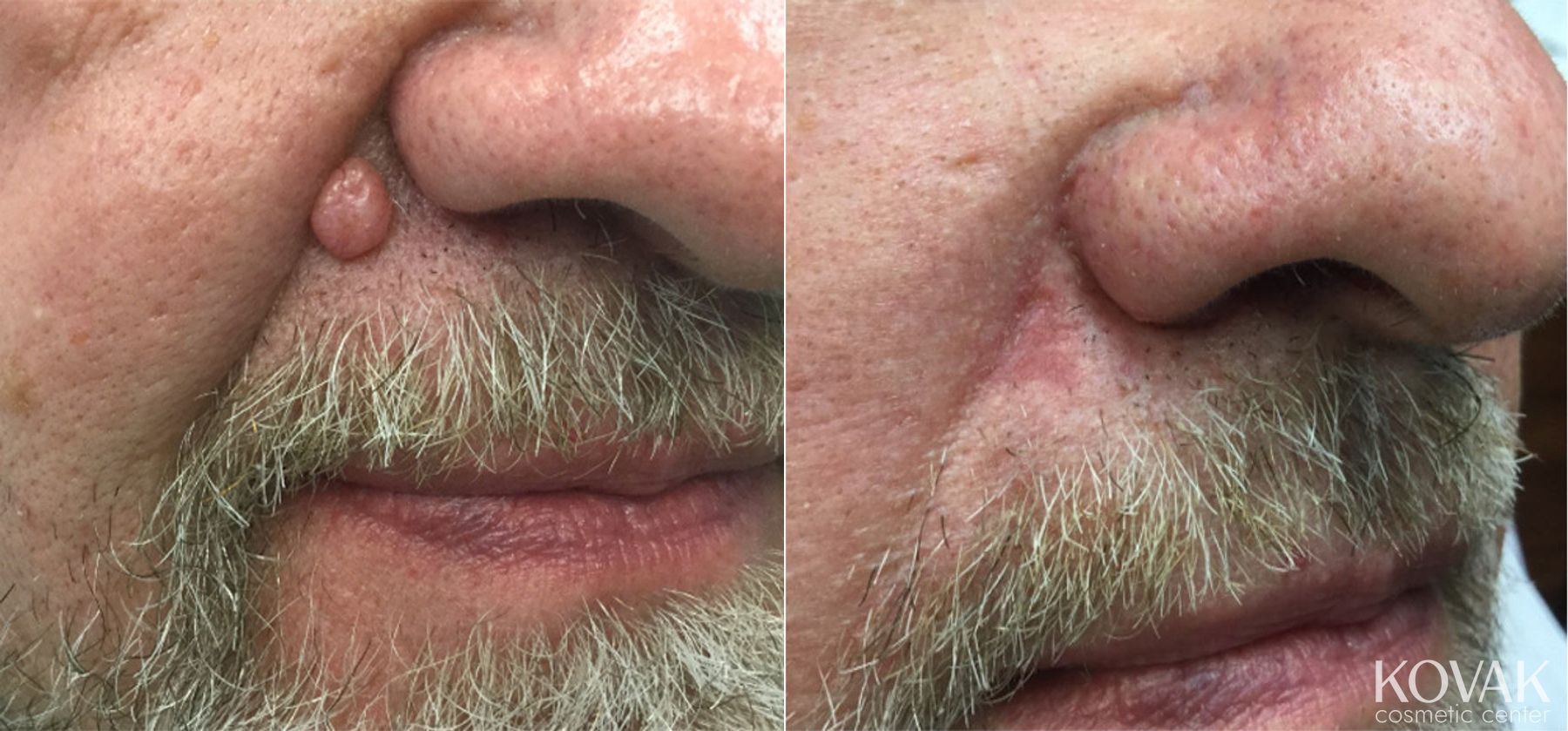 Before and after Mole Removal case 36512
