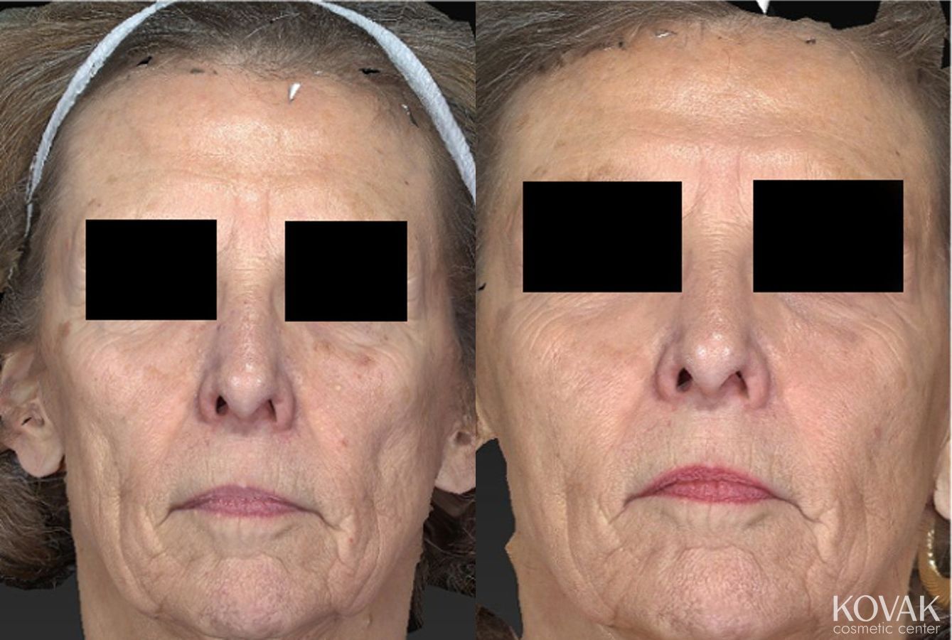 Before and after Sculptra® case 36493
