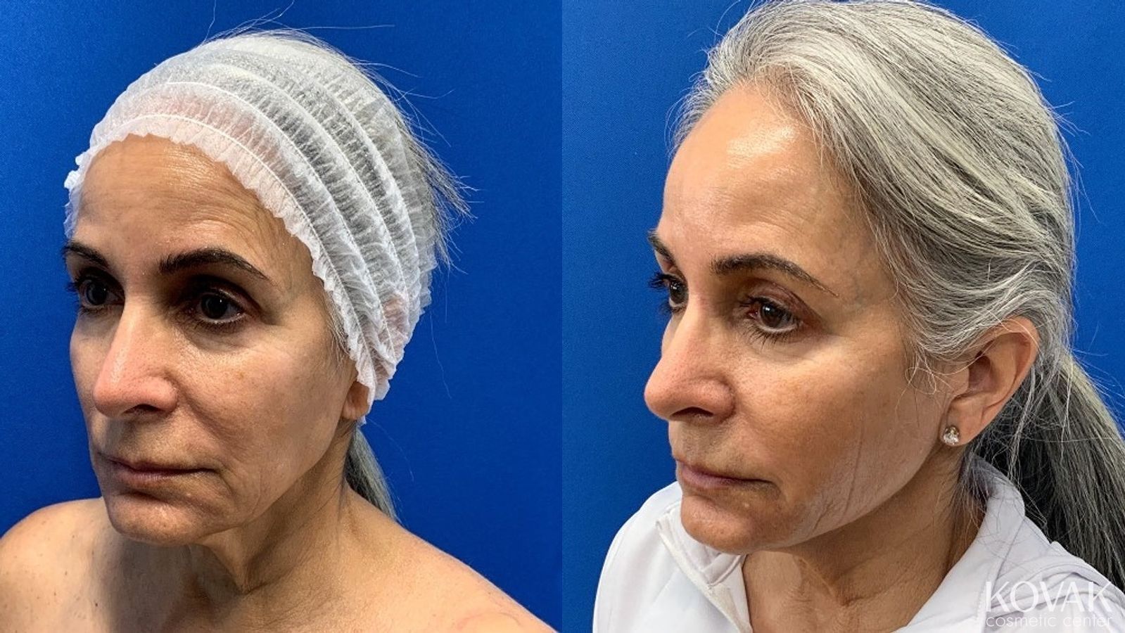 Before and after VLR - Vaser Laser - Jawline Sculpting case 36759 - Angle 2