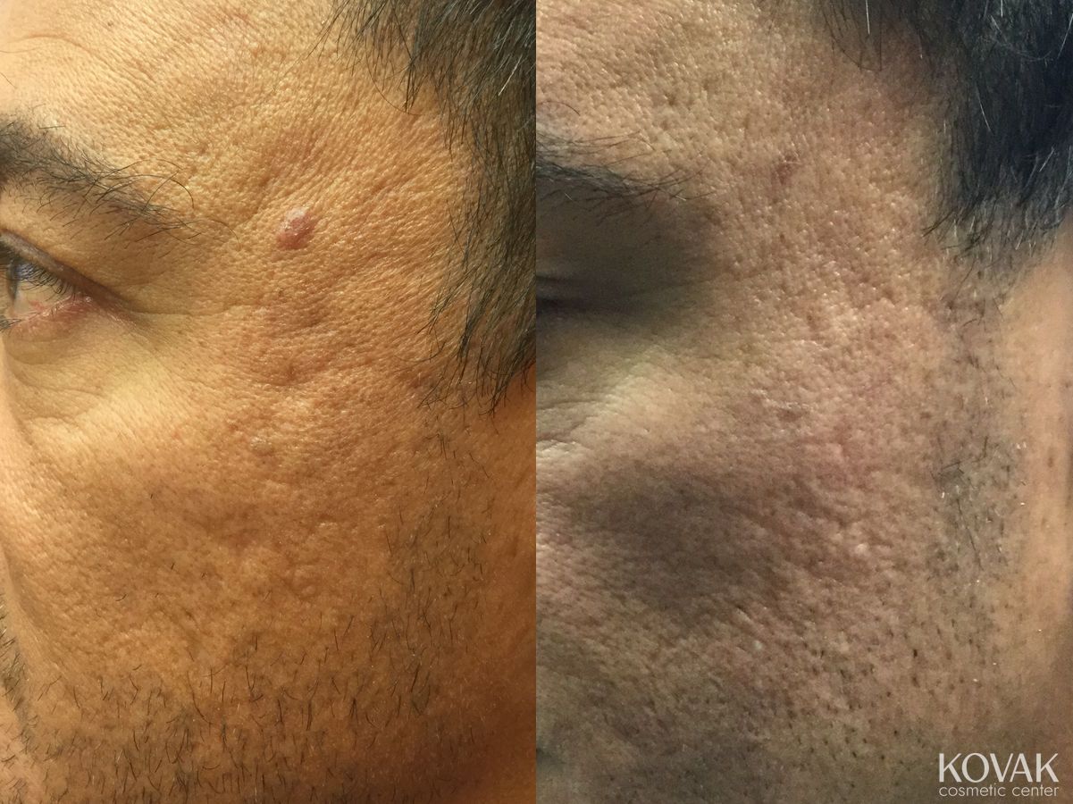 Before and after Acne Scars case 36614
