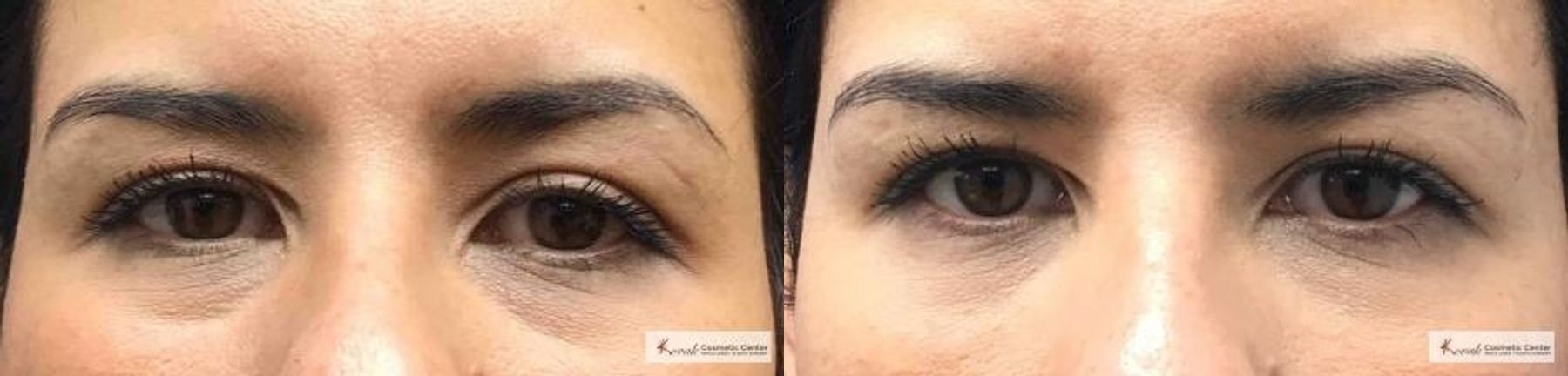 Before and after Restylane® Silk case 36447