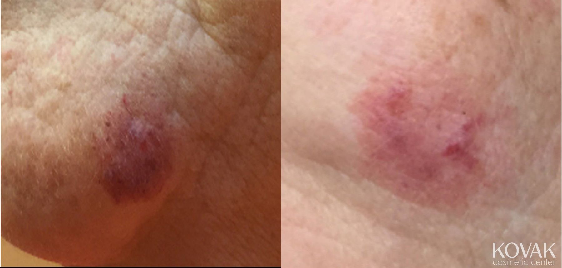 Before and after Port Wine Stain case 36487