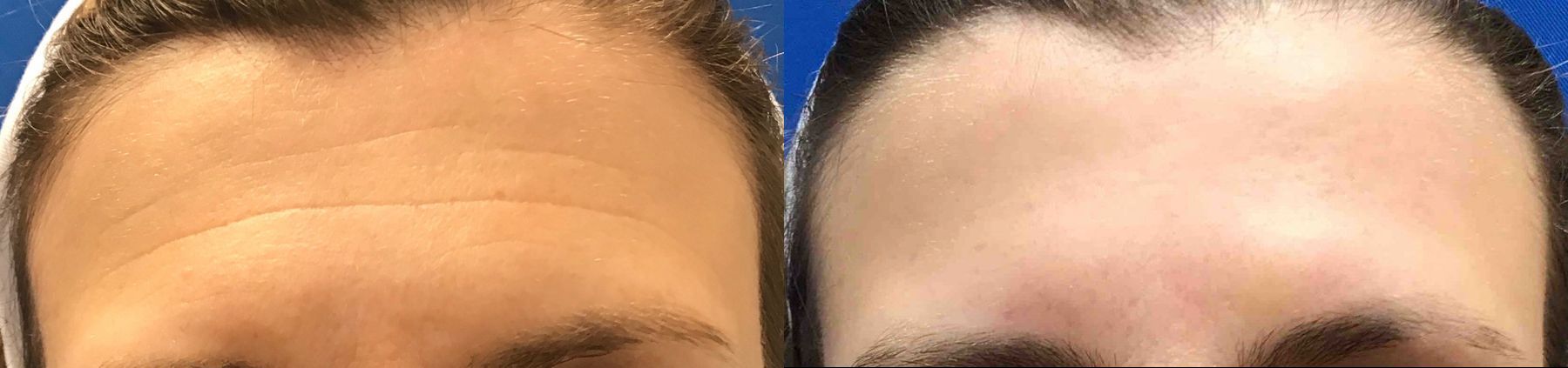Before and after Restylane® case 36630