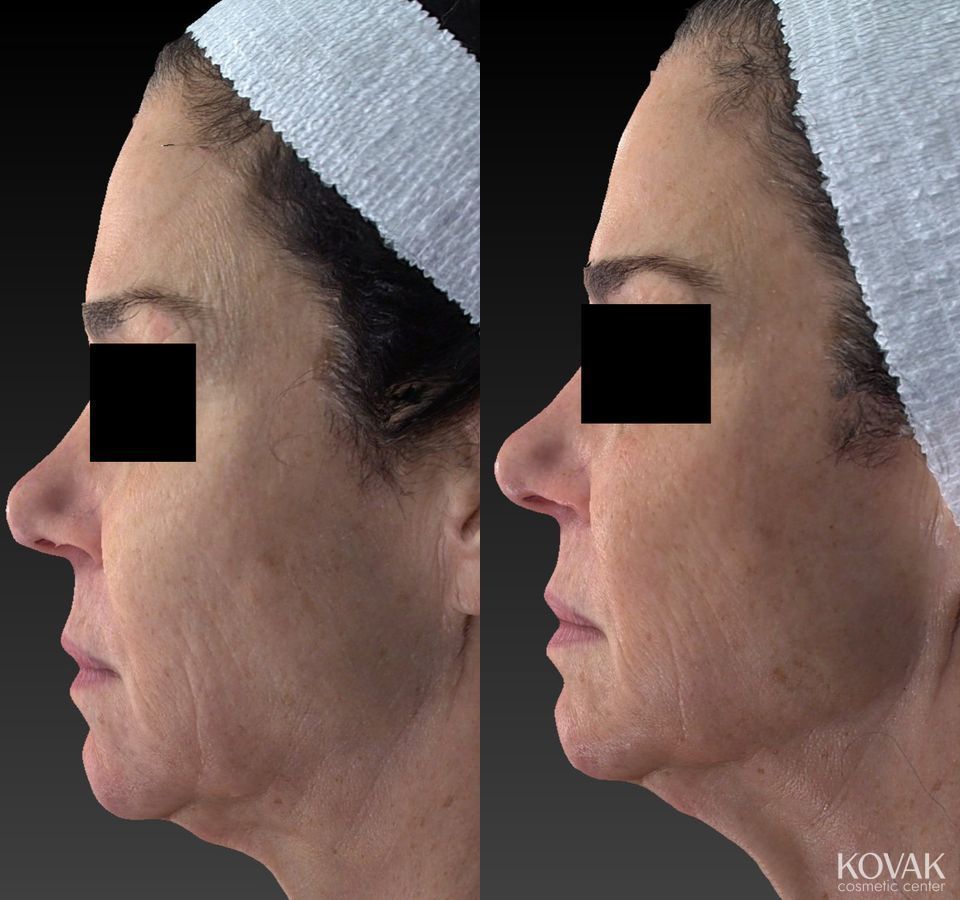 Before and after Halo™ case 36585 - Angle 2